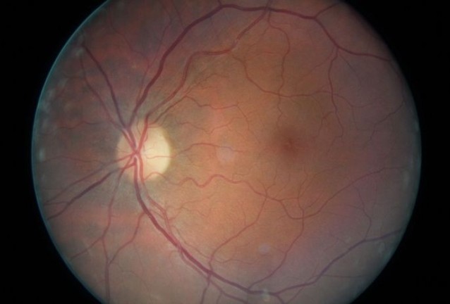 дегенерация дегенерация