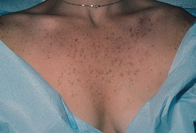 петна петна