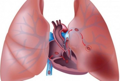 Времето на киселините може да показва образуване на кръвни съсиреци